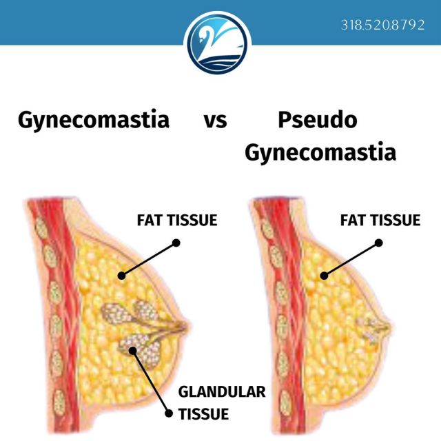 Men that have large or swollen breasts is more common than you might think. But how do you know if it's caused by excess chest fat - Pseudogynecomastia or if it's an excess of glandular tissue - Gynecomastia. More importantly, what can be done about it?

Both conditions display similar physical traits of an enlarged chubby or puffy chest. The difference is what is beneath the surface giving that appearance. A true gynecomastia is caused by an overdevelopment of glandular tissue. One at home test that you can do to determine if what you have is likely gynecomastia is to pinch the area around the nipple and if it feels firm or sensitive to the touch, it could be gynecomastia. However, if when you pinch the area it is soft like the rest of your breast tissue, it could be pseudogynecomastia which is just an accumulation of excess fat. 

Both gynecomastia and pseudogynecomastia are not health risks but it can have an affect on one's self-esteem and make them feel self-conscious to go shirtless. The only way to treat gynecomastia surgery successfully is to have gynecomastia surgery. 

Dr. Simeon Wall Jr. has extensive experience and expertise in this procedure and through his precision and skill, the incisions are incredibly small and inconspicuous. Both procedures often require SAFELipo to remove the excess fatty tissue, and the glandular tissue in a gynecomastia case is surgically removed. 

To schedule a consultation with Dr. Simeon Wall Jr. call 318.520.8792 or send us a DM on social media!

To see before and after pictures of some of our gynecomastia patients, check out our webpage.

#wallcenter #novisiblescars #safelipo #safelipohd #evl #plasticsurgery #boardcertifiedplasticsurgeon #shreveport #louisiana #dadbod #liposuction #breastaugmentation #hotbody #transformation #beforeandafter #moobs #gynecomastia #pseudogynecomastia #goshirtless #menshealth