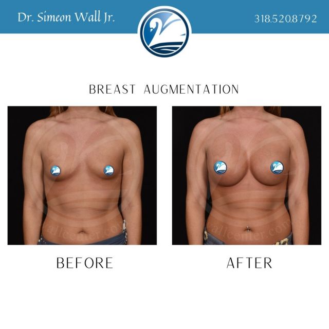 Is Breast Augmentation Right for You?
Excellent candidates for breast augmentation are healthy women who are excited about getting breast implants for their own personal reasons. The physical benefits of breast augmentation include:

Enlarging naturally small breasts
Minimizing breast asymmetry
Creating enhanced cleavage
Restoring fullness to breasts after weight loss or breastfeeding
Improving appearance and confidence in a variety of clothing styles

Women who have lost a significant amount of weight or have sagging breasts after childbearing may need to combine breast augmentation with a breast lift. Breast implants on their own will make breasts sag even more if the breast skin has lost elasticity and there is already moderate to severe ptosis, or sagging.

To schedule your #breastaugmentation consultation with Dr. Simeon Wall Jr. call 318.520.8792

#wallcenter #novisiblescars #safelipo #safelipohd #evl #plasticsurgery #boardcertifiedplasticsurgeon #shreveport #louisiana #mommymakeover #dadbod #liposuction #mombod #abdominoplasty #breastaugmentation #breastimplants #bbl #hotbody #transformation #bikiniready #beforeandafter