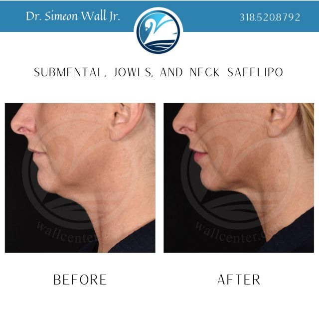 You may want to consider submental liposuction if you have:

~ Excess fat of the neck
~ A mild to moderate amount of excess skin of the neck
~ Loss of a defined jaw and neckline

To see if you are a good candidate for this surgical procedure, schedule a consultation with Dr. Simeon Wall Jr. 318.520.8792

To see if you would be a better candidate for a non-surgical procedure, call our Jade MediSpa and see if CoolSculpting or Kybella would be a better choice for you. 318.520.8792

#submentalfat #submentallipo #safelipo #coolsculpting #kybella #plasticsurgery #shreveportlouisiana #realpatient #realresults #beforeandafter
