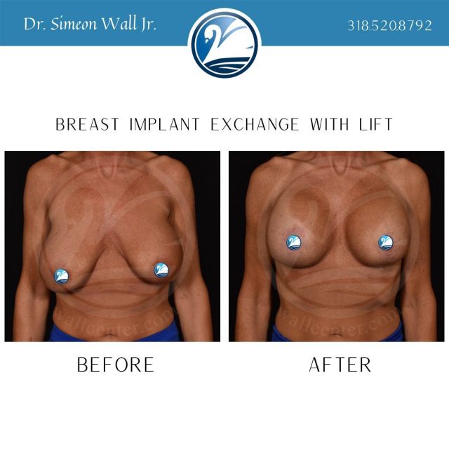 If you need a lift, get the lift. Breast Implant Exchange with Lift. #TEAMJR #implantexchangesurgery #plasticsurgery #boardcertifiedplasticsurgeon #breastlift #mastopexy #realpatient #realresults #beforeandafter