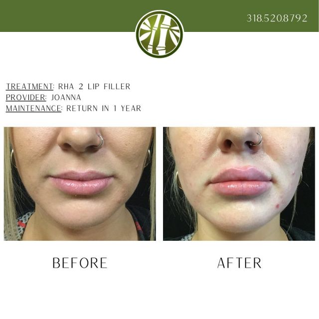 I like my lips like I like my wine. Full-bodied, bold, and opulent. 
To schedule your lip filler with Joanna, call 318.520.8792