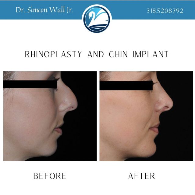 GET IN THE PHOTO! You may know that Dr. Simeon Wall Jr. is known around the world for his liposuction and fat grafting techniques, but did you know that #rhinoplasty surgery is one of the procedures he is most passionate about? Everyone should love their profile! Stop being camera shy. GET IN THE PHOTO with Dr. Simeon Wall Jr.’s rhinoplasty procedure. Recovery is much easier than you think. For a consultation call 318.520.8792