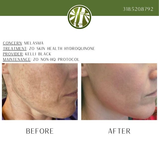 A couple days ago you saw us share amazing before and afters of our Aesthetician Alyne. Well, here is a patient who also has melasma and followed our ZO protocol. Doesn't her skin look amazing?!

@zoskinhealth @tell_me_more_sam