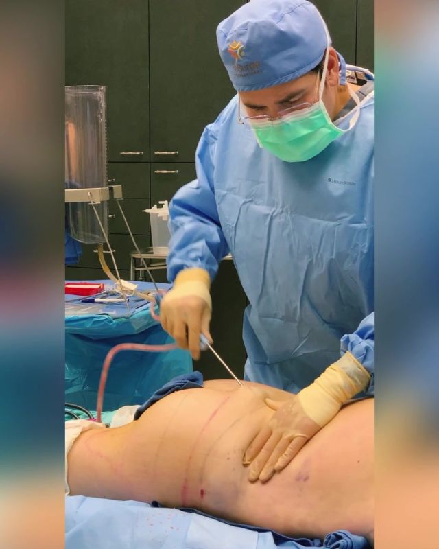 Dr. Simeon Wall Jr. is known around the world for creating and using his SAFELipo liposuction technique. The breakthrough technique evenly distributes a thin layer of fat just below the skin to prevent the contour irregularities associated with other liposuction techniques.

#wallcenter #nosisiblescars #safelipo #safelipohd #plasticsurgery #boardcertifiedplasticsurgeon #liposuction #transformation #shreveport #louisiana #teamJR