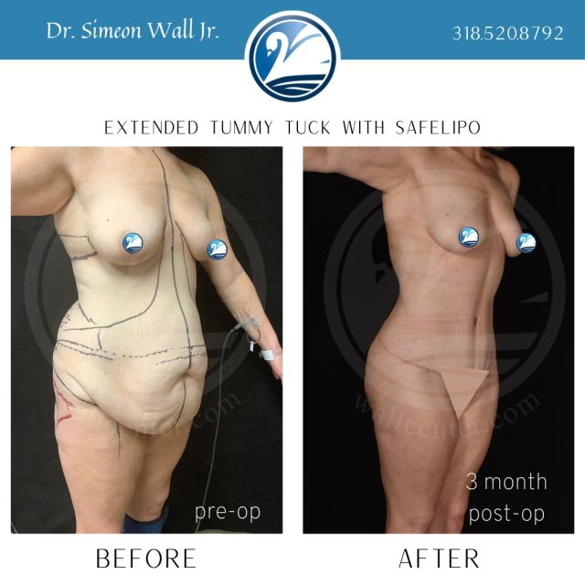 Is your jaw off the floor yet? Ours either 🤯😲 Check out this before and after of an extended tummy tuck with SAFELipo by Dr. Wall Jr. Are you interested in seeing what can be done for you? Call today and schedule a consultation! 

#wallcenter #novisiblescars #safelipo #safelipohd #evl #plasticsurgery #boardcertifiedplasticsurgeon 
#shreveport #louisiana
