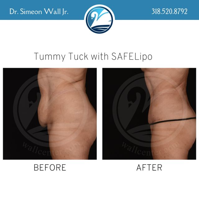 Dr. Wall Jr. never fails to amaze us! These results are incredible! Call us today to learn more about scheduling a consultation.

#beforeandafter #wallcenter #plasticsurgery #tummytuck #SAFELipo #teamJR #boardcertifiedplasticsurgeon #shreveport
