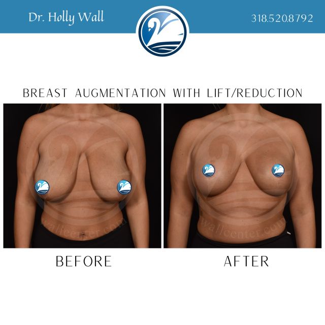 This patient wanted a breast augmentation with a lift and reduction, and Dr. Holly Wall came through with incredible results! Now is the perfect time to call and schedule a consultation with one of our physicians, and before you know it, your results could be next. 

#wallcenter #beforeandafter #teamholly #boardcertifiedplasticsurgeon #plasticsurgery #breastaugmentation #breastlift #breastreduction #louisiana #texas #arkansas