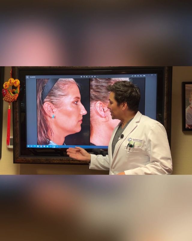 Dr. Wall Jr. explains a recent case of nose reshaping through open rhinoplasty. He also discusses some alternative options to a facelift to achieve your desired outcome. 

#rhinoplasty #beforeandafter #openrhinoplasty #SAFELipo #plasticsurgery #boardcertifiedplasticsurgeon #teamJR #wallcenter #shreveport #louisiana #texas #arkansas