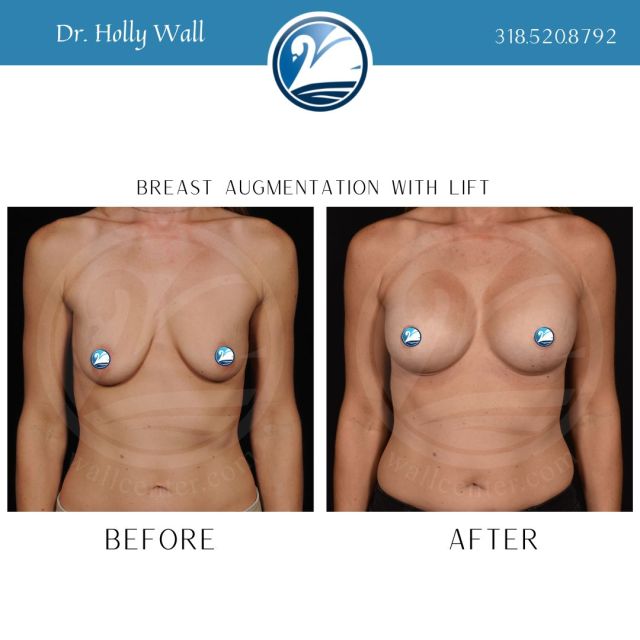 You can have the breasts of your dreams! Call us today to schedule a consultation with Dr. Holly Wall!✨

#beforeandafter #dreambody #teamholly #breastaugmentation #breastlift #wallcenter #boardcertifiedplasticsurgeon #shreveport #louisiana #texas #arkansas