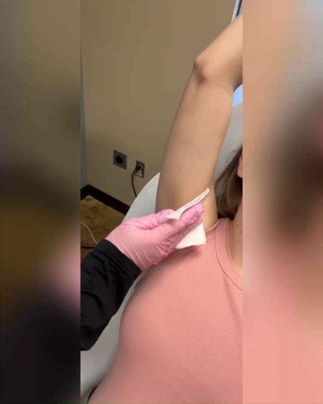 A question we get often is how long it takes for laser hair removal session. As you can see, it takes less than a minute to do one armpit. Each area of the body may vary, but overall it's very quick and essentially painless! On average, it takes 6-8 treatments to get maximum results, but each person is different. Don't forget about our monthly specials -- buy 6 sessions, get 2 free! Call us today to schedule your appointment and get ready for summer!☀️