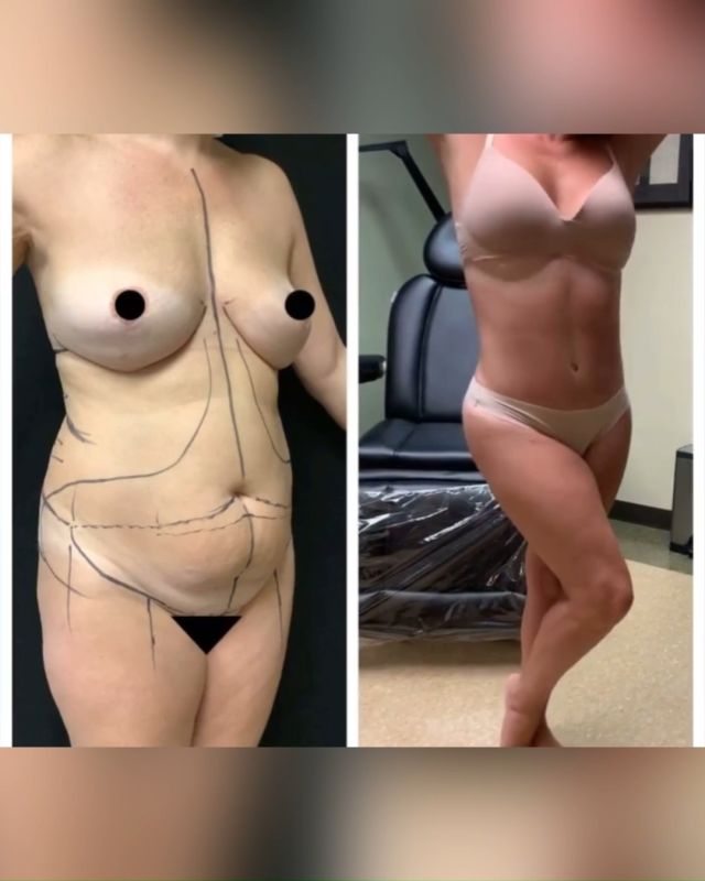 We're doing a happy dance over these amazing before and after results of a tummy tuck and 360 SAFELipo with Dr. Simeon Wall Jr. 🤩

#safelipo #safelipo360 #teamJR #beforeandafter #happydance #loveyourbody #amazingresults #wallcenter #plasticsurgery #cosmeticsurgery #boardcertifiedplasticsurgeon #toptiersurgeon #shreveport
