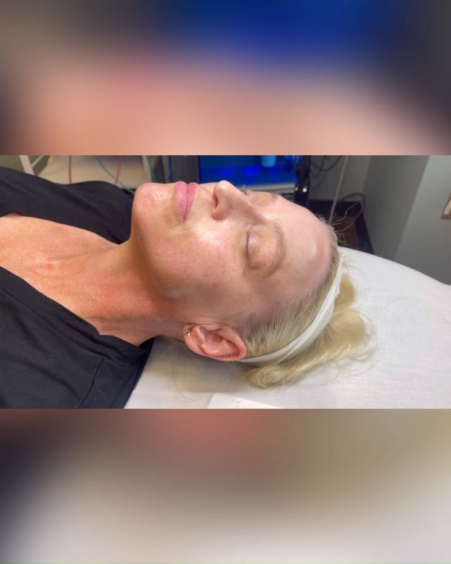 Dermaplaning is a service we offer at Jade MediSpa that gets rid of all the dead skin, dirt, vellus hair and makeup lingering on your face. If you watch til the end of this video, you'll see how much came off this patient's face, even after being washed!

#dermaplaning #aesthetics #face #facecare #skincare #esthetician #treatment #service #jademedispa #shreveport #louisiana #loveyourskin #aestheticjourney