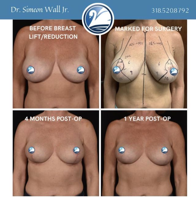 You do not have to be afraid of scars from a breast lift! Trust the process—our board certified plastic surgeons have long-term results in mind when planning your operation. Check out these before and after pictures of one of our patients over a 1-year period.