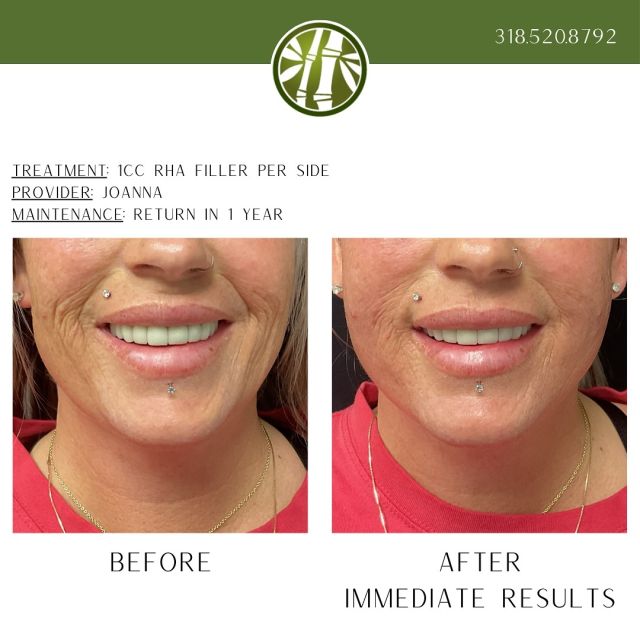 These results are immediately after just 1cc of RHA 4 filler per side with our amazing NP Joanna! These results typically last at least a year and possibly longer. See what Jade MediSpa can do for you, and join our Jade Club for low monthly payments. 318.520.8792
