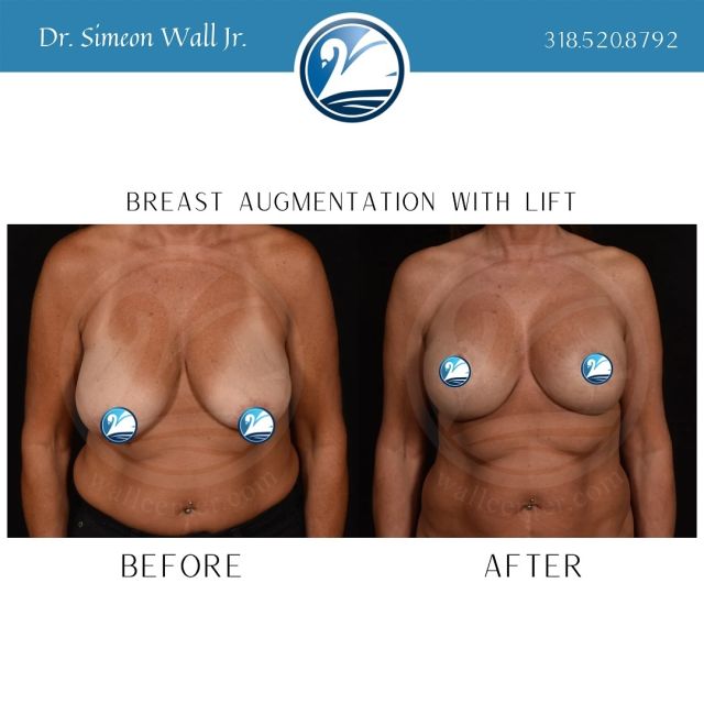 Gorgeous breast augmentation with lift results from Dr. Simeon Wall Jr.!
#breastaugmentation #breastlift #realpatientsrealresults