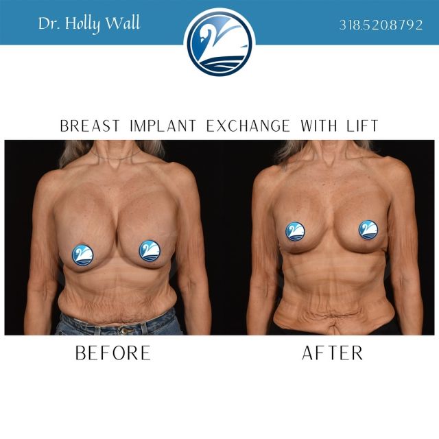 🌟 Surgical Transformation: Breast Implant Exchange and Lift 🌟

As a board-certified plastic surgeon, I had the privilege of assisting a patient in their journey towards a breast implant exchange to a smaller size with a lift. 💪

Through a thorough consultation and careful planning, we tailored a personalized surgical plan to meet the patient’s aesthetic goals and ensure their safety and satisfaction. 🌺

The procedure was executed with precision and care, resulting in a successful transformation that not only enhanced the patient’s physical appearance but also boosted their self-confidence and well-being. 💖

It is truly rewarding to witness the positive impact that such surgeries can have on an individual’s life and self-image. 🌸 
  Schedule your consultation with Dr. Holly Wall by calling 318.520.8792
#PlasticSurgery #BreastImplantExchange #BreastLift #PatientCare #realpatientsrealresults #shreveportplasticsurgery