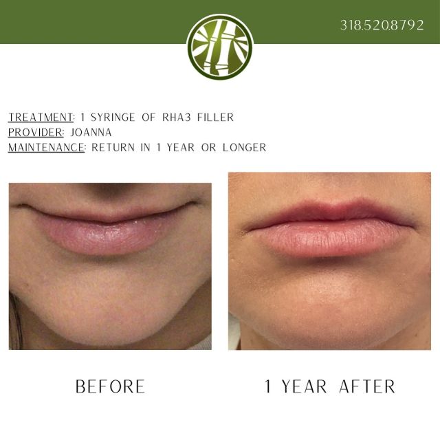 You read that right! These lip filler results are 1 YEAR after injection. If you want more symmetry of your lips, schedule your free consultation with Joanna, call 318.520.8792.