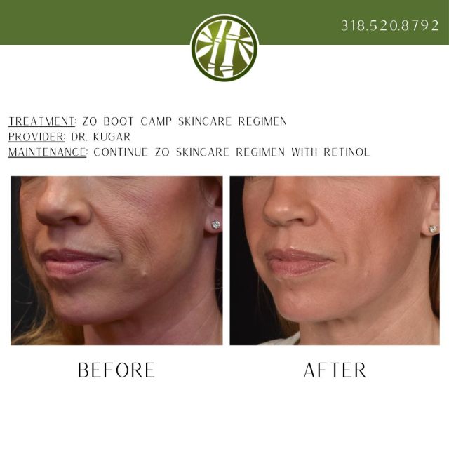 Happy Friday!🎉 Check out these awesome before and after results! This patient participated in the ZO Bootcamp, a four week skincare regimen including the Hydrating Cleanser, Exfoliating Polish, Complexion Pads, and the all new Complex A retinol treatment. The goal of the bootcamp is to help with skin texture, quality, and brightness, and this patient got exactly that! To learn more or schedule a consultation, call us at 318-520-8792!
