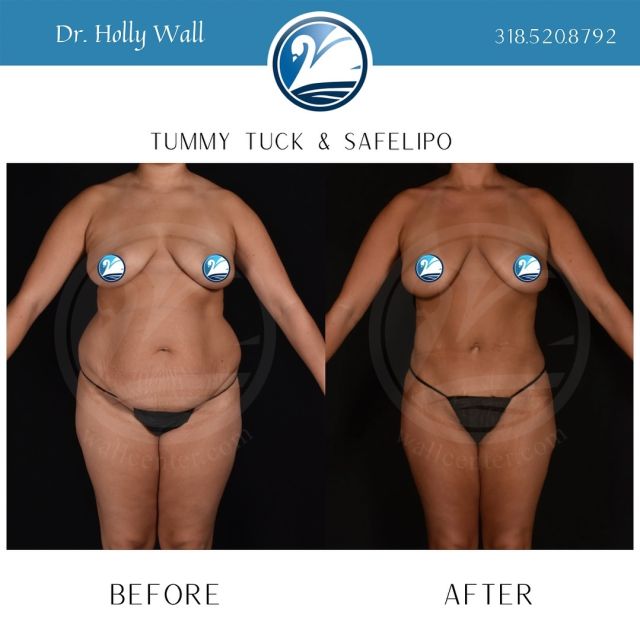 How long will your #tummytuck and #lipo results last? With proper diet and exercise, your results could last indefinitely. This patient’s after picture is 8 years post-op and still looks amazing!