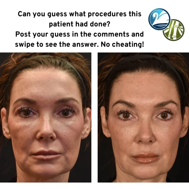Can you guess what procedures this patient had done? Post your guesses in the comments and then swipe right for the answer. No Cheating 😉!