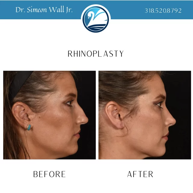 ✨ Rhinoplasty Transformation! ✨

Check out this beautiful before and after from our patient who underwent a rhinoplasty with board-certified plastic surgeon Dr. Simeon Wall Jr. 💫 

Before, she felt her nose didn’t complement her features. After the procedure, she has a refined profile that enhances her natural beauty! 🌟

Ready to boost your confidence? Contact us today for a consultation! 💖Call 318.520.8792 or Text 318.523.2722

#Rhinoplasty #BeforeAndAfter #drsimeonwalljr #ConfidenceBoost