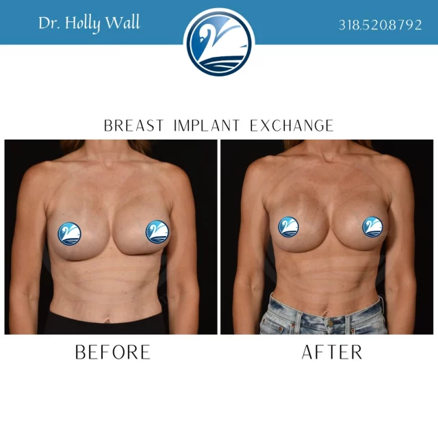 What does a ruptured implant look like? Well, that can depend on what type of implant you have. Saline implants usually just look deflated. Gel implants, like the ones pictured, may look uneven, smaller, or in this case of a left implant rupture...oddly contoured. But sometimes, you can't tell at all. At The Wall Center, we offer ultrasound screenings to monitor for ruptures. If you are noticing any of these changes in your breasts, we want to see you. Call 318.520.8792 or Text 318.523.2722 to schedule a consultation or follow-up appointment. 

 #beforeandafter #plasticsurgeryresults #plasticsurgerybeforeandafter #beforeafter #boardcertifiedplasticsurgeon #plasticsurgery #breastimplantrupture #rupturedbreastimplant #breastimplantexchange