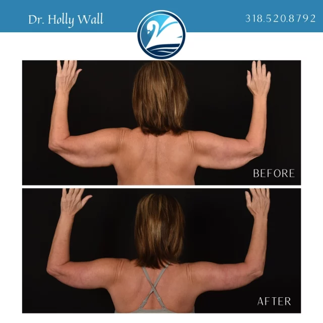 It's too hot in Louisiana to be wearing sleeves this summer. Stop hiding your arms and set them FREE! Say "YES" to sleeveless this summer by scheduling your consultation for an arm lift today! 318.520.8792

 #boardcertifiedplasticsurgeon #plasticsurgery #beforeafter #beforeandafter #plasticsurgerybeforeandafter #armlift #brachioplasty #sleeveless