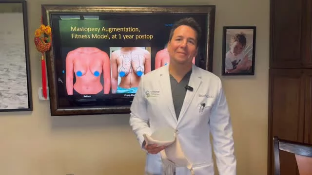 After a breast augmentation, why does your bra size increase “not match” the size increase of the breasts? Dr. Simeon Wall Jr. explains this perfectly with informative visuals. Do you have any topics you’d like our surgeons to cover in a future video? Post your suggestions below and we might use your ideas in a future post! #boardcertifiedplasticsurgeon #plasticsurgery #breastaugmentation