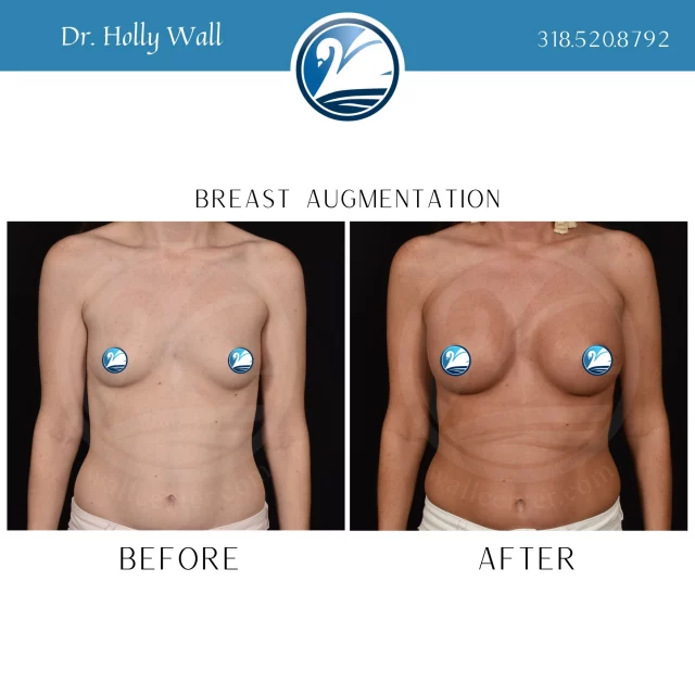 295cc was all it took to create these beautiful, natural results. The confidence this patient has now is priceless! Text "Aug Info" to 318.523.2722 for more info.
