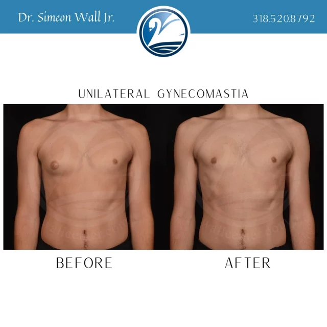 Unilateral gynecomastia is a medical condition characterized by the enlargement of breast tissue in one breast, leading to asymmetry. This can occur due to hormonal imbalances, certain medications, or other underlying health issues. While it can affect individuals of all ages, it’s often noticeable during puberty or in adult men. Many seek treatment for unilateral gynecomastia to alleviate physical discomfort and improve self-esteem. A variety of surgical options are available to restore a more masculine contour and balance. If you’re experiencing this condition, consulting with a specialized board certified plastic surgeon like Dr. Simeon Wall Jr., can provide treatment options tailored to your needs. Call 318.520.8792 or Text “Gynocomastia info” to 318.523.2722. #gynecomastia #gynecomastiasurgeon