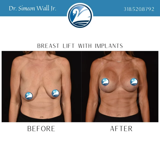 Are you ready to elevate your breasts to the next level? Text "breast info" to 318-523-2722 for more information!

 #breastliftandaugmentation #breastliftwithimplant #breastliftsurgery #breastaugmentations #boardcertifiedplasticsurgeon #plasticsurgery #plasticsurgeryresults #beforeandafter