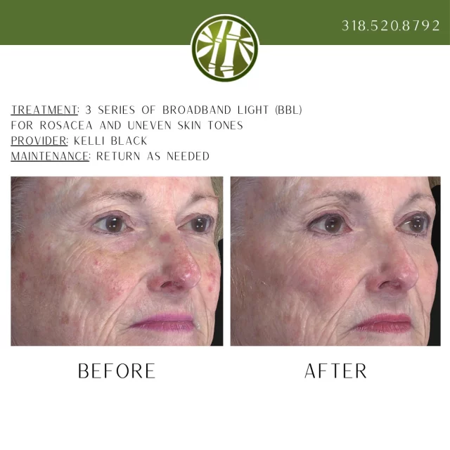 Your Fall Skin Reset 🍂

Whether you're tackling post-summer sun damage or
just in the mood for a skin refresh, our facial and BBL
laser treatments are here to revive, refine, and reveal
your best glow yet.

This month only—buy any 2 facials or BBL treatments
and get 1 FREE! Mix and match however you like:

• Facials: Customized, medical-grade facials designed
to cleanse, exfoliate, and deeply nourish. Enjoy visibly
smoother, clearer, and more hydrated skin.
• BBL™ (BroadBand Light): Non-invasive light therapy
that targets sun damage, redness, and uneven tone
while stimulating collagen for long-term skin clarity and
glow.

It’s the ultimate excuse to treat your skin and stack up
serious results. Book your appointment while this offer
lasts!

TEXT "August Special Me" to 318.523.2722 for more
information!