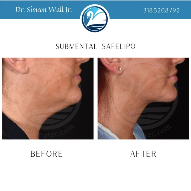 Go from "just fine" to "foine" with one procedure. To learn more about Submental SAFELipo, text "neck lipo info" to 318.523.2722.

#submentallipo #submentalliposuction #safelipo #safeliposuction #neckliposuction #foine