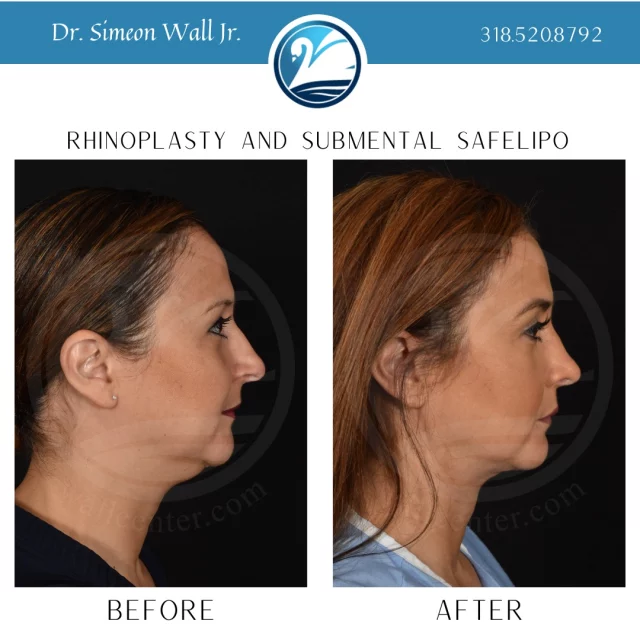 Have you been considering a rhinoplasty or submental liposuction? Or maybe both? We are here to give you more info and answer any questions you may have. Just text "face with teamJR" to 318.523.2722

 #liposuctıon #SafeLipo #beforeandafter #plasticsurgeryresults #plasticsurgerybeforeandafter #beforeafter #boardcertifiedplasticsurgeon #plasticsurgery #rhinoplasty #submentallipo #submentalliposuction #submentalfat #nosejob