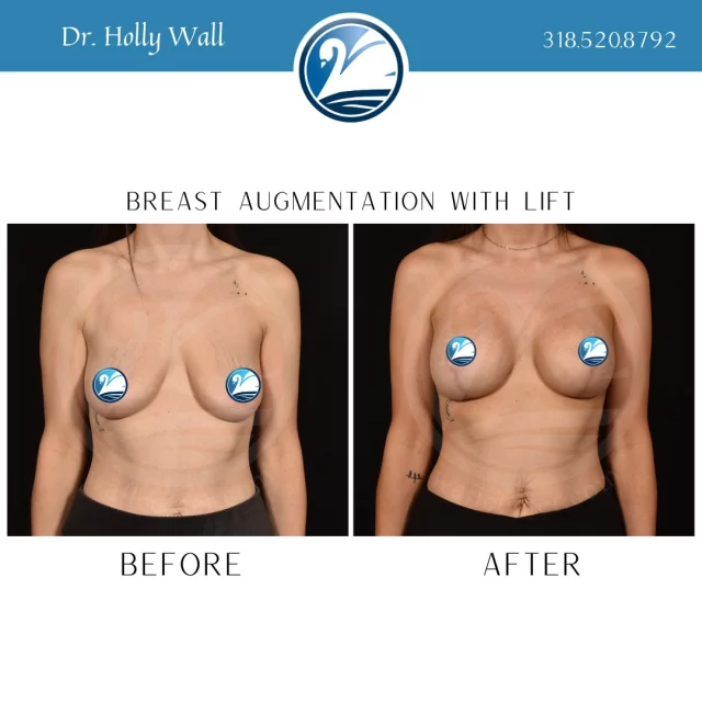 Want to save $500 on a breast augmentation? Text "Save me $500" to 318.523.2722 for more info!

 #beforeandafter #plasticsurgeryresults #plasticsurgerybeforeandafter #breastliftandaugmentation #breastliftwithimplant #breastliftsurgery #breastaugmentations #boardcertifiedplasticsurgeon #plasticsurgery