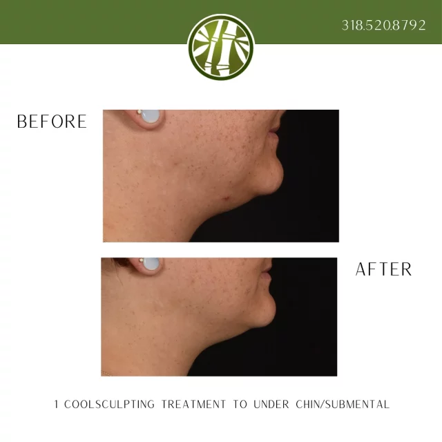 🌟 Transform Your Profile! 🌟

Say goodbye to stubborn fat under the chin with CoolSculpting! Check out this incredible before and after transformation. 

✨ Before:  Feeling self-conscious about your profile? 
✨ After:  Look at the difference after just 1 treatment! A more defined jawline and boost in confidence! 

Ready to sculpt your dream look? 💪 Learn more by texting “CoolSculpting Chin Info” to 318.523.2722

#CoolSculpting #BodySculpting #ChinFat #ConfidenceBoost #TransformYourself