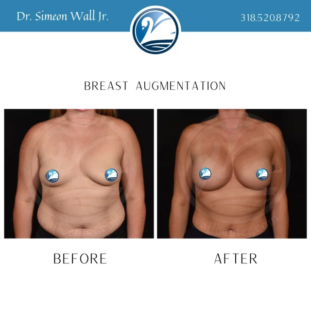 Did you know that for a limited time, you can save $500 on a breast augmentation? For more information, text "Save me $500" to 318.523.2722.
