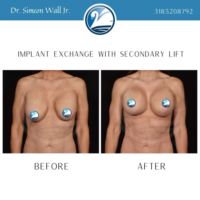 You just said "WOW" in your head didn't you?! Well, we agree with you. You deserve to get what you want. You don't have to settle for life changes when a second surgical procedure can change your life. For more information text "Exchange Info" to 318.523.2722 or just give us a call, 318.520.8792.

 #beforeandafter #plasticsurgeryresults #plasticsurgerybeforeandafter #beforeafter #breastliftandaugmentation #breastliftwithimplant #breastaugmentations #breastliftsurgery #boardcertifiedplasticsurgeon #plasticsurgery #implantexchange