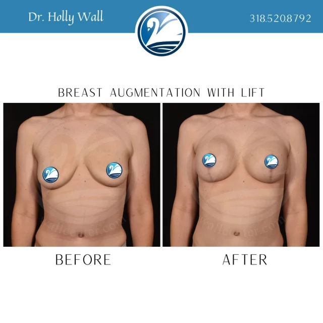 This before and after is a good example of why your bra size may not change much after a breast augmentation, even though your breasts are larger. 

In the before image you can see that most of this patient's breast volume is in the bottom of the breast which would be completely covered by a bra. 

In the after image you can see that there is about equal breast tissue in the top and bottom of the breasts with only the bottom half being covered by the bra. This extra volume above the bra is not measured in your bra cup but gives you the beautiful cleavage and upper breast pole fullness that you desire. 

If you are ready to schedule a consultation with Dr. Holly, TEXT "Consult with Dr. Holly" to 318.523.2722 or CALL 318.520.8792.