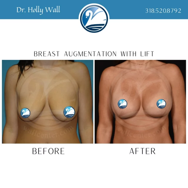 Almost 15 years post-op from a breast lift with implants and still looking absolutely incredible! Are you ready to elevate your breasts to the next level? Text "breast lift info" to 318.523.2722 to learn more about this procedure!

 #beforeandafter #plasticsurgeryresults #plasticsurgerybeforeandafter #breastliftandaugmentation #breastliftwithimplant #breastliftsurgery #breastaugmentations #boardcertifiedplasticsurgeon #plasticsurgery