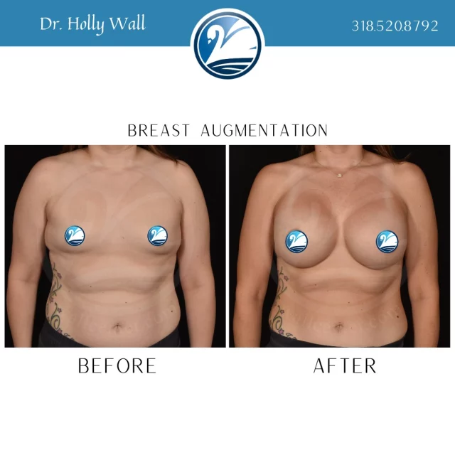 Get the breasts you've always dreamed of! Are you ready to put you first?! Text "breast aug info" to 318.523.2722 and see just how easy we can make your dreams come true.

 #beforeandafter #plasticsurgeryresults #plasticsurgerybeforeandafter #beforeafter #breastaugmentations #boardcertifiedplasticsurgeon #plasticsurgery