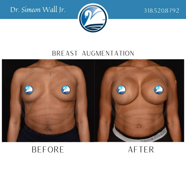 Making mountains out of mole hills. It's what we do. 

Are you ready to take the first step towards a better self-image? If a breast augmentation has been on your dream-list, we can make it happen! Text "breast aug" to 318.523.2722 for more information.