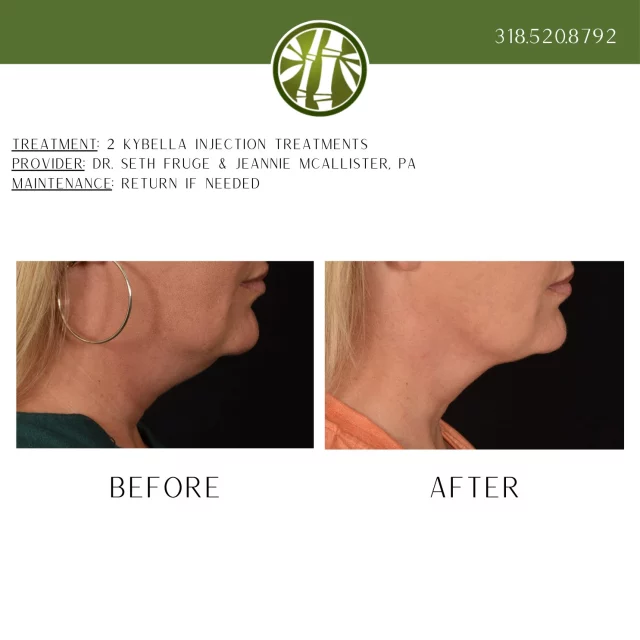 This patient sought double chin reduction in Shreveport after feeling self-conscious about her profile. She wanted a non-surgical solution that would help her feel more confident in photos and everyday interactions. After a personalized consultation, she decided to proceed with Kybella injections to target submental fullness.

20% Off Kybella Treatments this month!!!

This patient's treatment involved two separate Kybella sessions. The after photo was taken two months after her final procedure, showing a noticeable reduction in her double chin. The patient’s neckline now appears more defined, helping her feel more comfortable and at ease.

Our Jade MediSpa providers ensured her questions and concerns were addressed at every step. As part of The Wall Center for Plastic Surgery in Shreveport, they continue to support patients seeking natural-looking results with minimally invasive techniques. 

To learn more about Kybella treatments, TEXT "Kybella info" to 318.523.2722.
#kybella #kybellatreatment #kybellainjection #kybellabeforeandafter