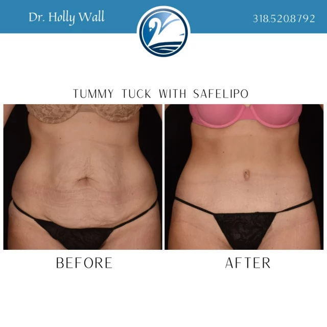 The changes to a woman's body during pregnancy is nothing short of amazing! The skin's ability to stretch to accommodate for the precious growing human is just one of many changes during pregnancy. After your body has done it's job, you might be left with stretched out skin and separated muscles. If you are bothered by these changes, we can help. If you want to inquire more about a tummy tuck, TEXT "tummy tuck info" to 318.523.2722.

 #liposuctıon #SafeLipo #tummytuckbeforeandafter #tummytucksurgery #TummyTuckTransformation #TummyTuck #extendedtummytuck #beforeandafter #plasticsurgeryresults #plasticsurgerybeforeandafter #boardcertifiedplasticsurgeon