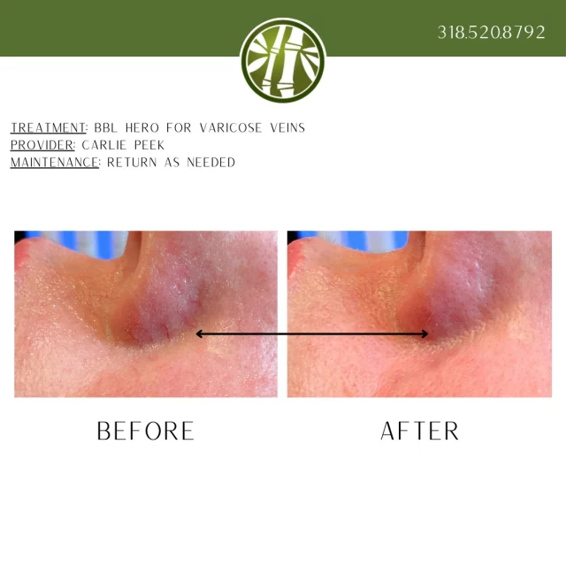 Check out this incredible disappearing act! These are immediate results after just 1 treatment for varicose veins using our BBL Hero. Although sometimes multiple treatments are necessary to achieve results like these, this patient is thrilled with her results from just 1 treatment. 

BBL Hero uses broadband light technology to penetrate the skin and target specific pigments and blood vessels. The treatment stimulates collagen production and promotes skin regeneration, resulting in a more youthful and even-toned appearance. 

During the month of October, you can get this treatment for 20% off by pre-paying. Just TEXT "BBL Hero 20% off" to 318.523.2722.