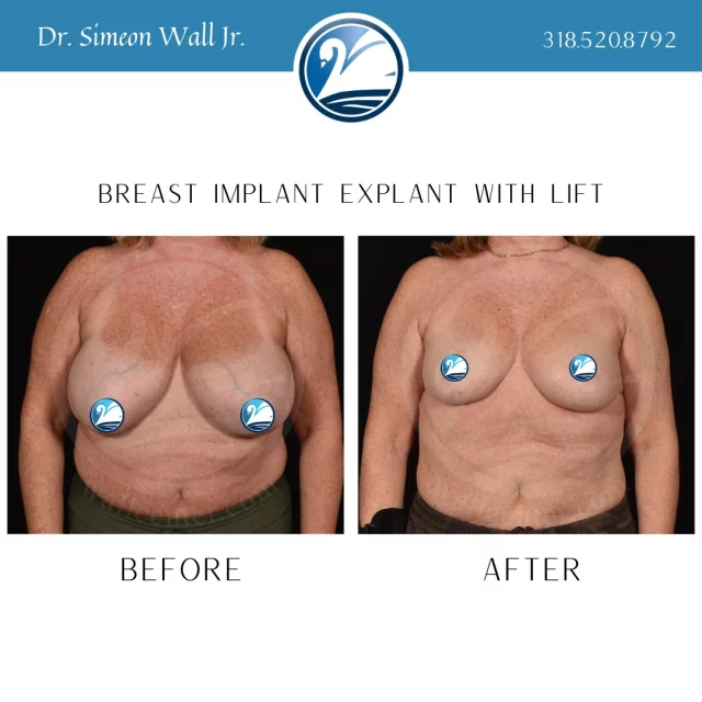 Sometimes, weight gain and aging after a breast augmentation can result in larger and lower breasts. Some patients, like this one, choose to just get the implants removed and have their breasts lifted. This patient is loving her natural results with less back and shoulder pain. If you would like more information about this procedure, TEXT "Explant Info" to 318.523.2722.

 #beforeandafter #plasticsurgeryresults #plasticsurgerybeforeandafter #breastliftsurgery #boardcertifiedplasticsurgeon #breastimplantremoval #breastreduction #breastlift