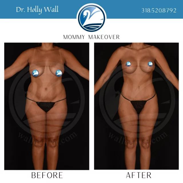 Don't mind Dr. Holly over here spreading a little Holly-Day Magic! 
For mommy makeover info text "mommy makeover" to 318.523.2722.

 #SafeLipo #liposuctıon #TummyTuckTransformation #safelipo #tummytuckbeforeandafter #tummytucksurgery #TummyTuck #extendedtummytuck #beforeandafter #plasticsurgeryresults #plasticsurgerybeforeandafter #breastliftandaugmentation #breastliftwithimplant #breastliftsurgery #breastaugmentations #boardcertifiedplasticsurgeon #plasticsurgery  #shreveportplasticsurgery #shreveport