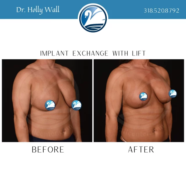 So maybe you went to the wrong plastic surgeon, who didn't give you honest treatment recommendations explaining why you couldn't get away with just a breast augmentation. That's okay, because you knew exactly where to go to get them fixed. At The Wall Center for Plastic Surgery, our board certified plastic surgeons may not always tell you what you want to hear but they will tell you what you need to hear. It's okay to price shop at the grocery store, but don't price shop your plastic surgery. Find out more info about implant exchanges by texting "exchange info" to 318.523.2722.

 #beforeandafter #plasticsurgeryresults #plasticsurgerybeforeandafter #breastliftandaugmentation #breastliftwithimplant #breastliftsurgery #breastaugmentations #boardcertifiedplasticsurgeon #plasticsurgery #implantexchange✔️