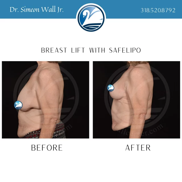 This is a footprint-elevating breast lift with SAFELipo of the entire frame around the breasts.  The entire position of the breast is elevated higher on the chest wall, with a much more desirable height, upper breast fullness higher on the chest, and a narrower, sleeker, longer look to the entire body. 

If you are ready to elevate your breasts to the next level, TEXT "breast lift info with SWJ" to 318.523.2722

 #SafeLipo #liposuctıon #beforeandafter #plasticsurgeryresults #plasticsurgerybeforeandafter #beforeafter #breastliftsurgery #boardcertifiedplasticsurgeon #plasticsurgery