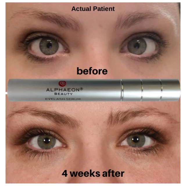 Naturally long eye-lashes are always in-style! Get longer and thicker eyelashes in just weeks with AlphaLash $99 or Latisse $165! 

#alphalash #latisse #eyelashserum #eyelashes #alphaeon